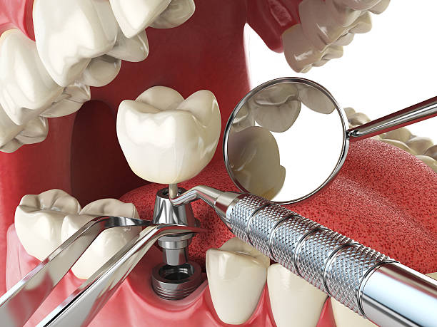 Best Emergency Dental Care for Broken or Chipped Teeth in Monongah, WV